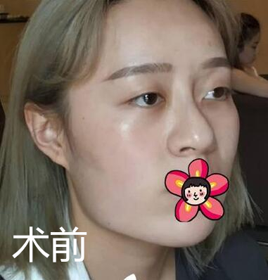 北京基礎(chǔ)美下頜角整形案例效果分享，黃大勇果然名不虛傳