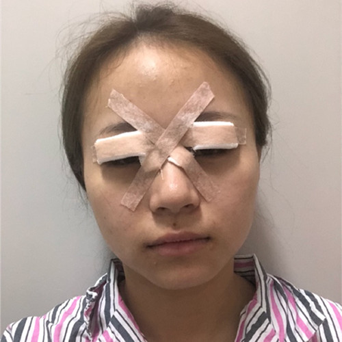 杭州靜港林忠泵埋線雙眼皮案例1-7天效果圖分享，讓你的眼睛魅力四射