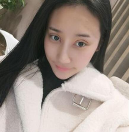 北京葉子整形美容醫(yī)院做焊接雙眼皮效果怎么樣？北京葉子整形焊接雙眼皮案例展示