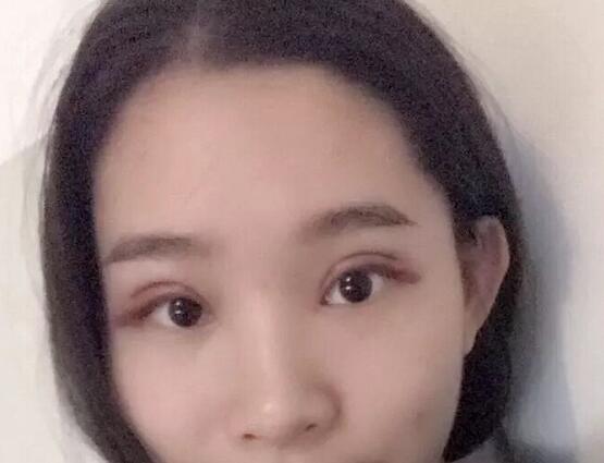 鄭州蕾娜斯彭沖醫(yī)生做微創(chuàng)雙眼皮案例效果對(duì)比圖