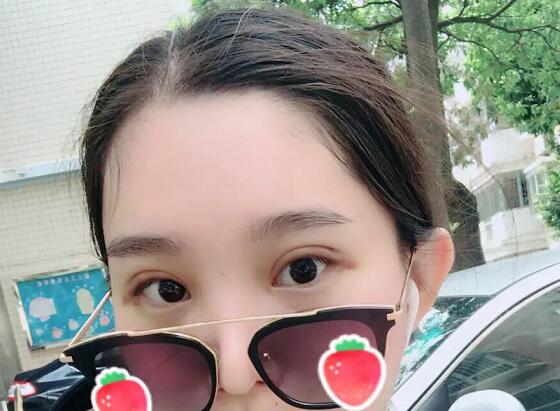 鄭州蕾娜斯彭沖醫(yī)生做微創(chuàng)雙眼皮案例效果對(duì)比圖