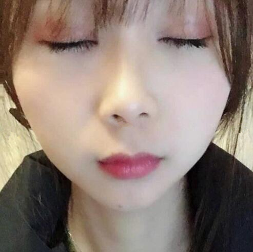 眼綜合整形手術(shù)半個(gè)月。