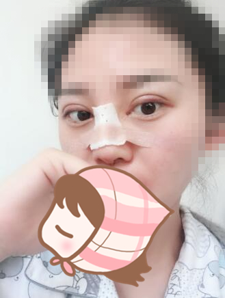 術后60天效果。