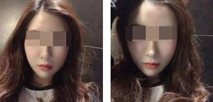 術前照片