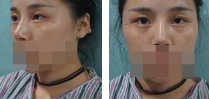 寧波美仁整形美容醫(yī)院李英大醫(yī)生做切開雙眼皮效果怎么樣？