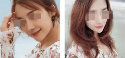 上海攸維醫(yī)療美容診所整形醫(yī)生李靜做膨體隆鼻效果怎么樣？附案例展示