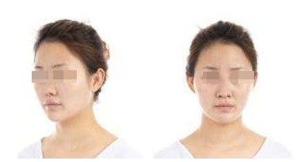 蘭州美月整形美容醫(yī)院文輝才醫(yī)生做鼻綜合整形效果怎么樣？附鼻綜合案例