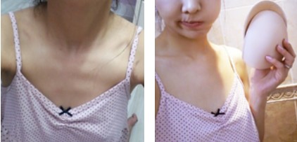 沈陽杏林整形美容醫(yī)院崔昌墉醫(yī)生做假體隆胸技術(shù)怎么樣？附案例