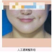 德州市第二人民醫(yī)院燒傷美容整形科張波濤醫(yī)生做酒窩成形術(shù)怎么樣？