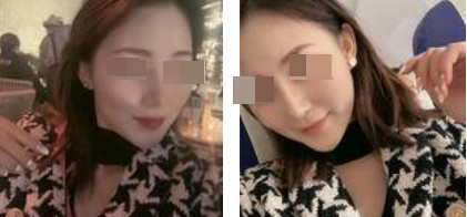 蘭州美月整形美容醫(yī)院文輝才醫(yī)生做鼻綜合整形效果怎么樣？附鼻綜合案例