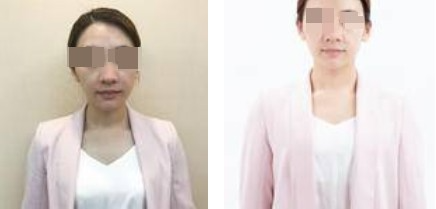 上海攸維醫(yī)療美容診所整形醫(yī)生李靜做膨體隆鼻效果怎么樣？附案例展示