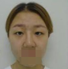 做了全切雙眼皮不僅外表變美了，內(nèi)心也更加自信了
