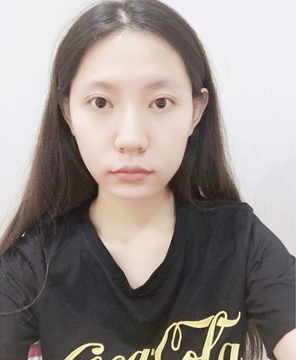  濟南安美醫(yī)療整形醫(yī)生李思思下頜角整形案例