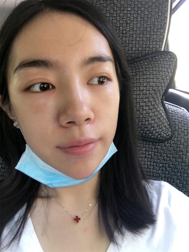 合肥壹加壹整形美容醫(yī)院做祛眼袋效果怎么樣？金大生祛眼袋案例分享
