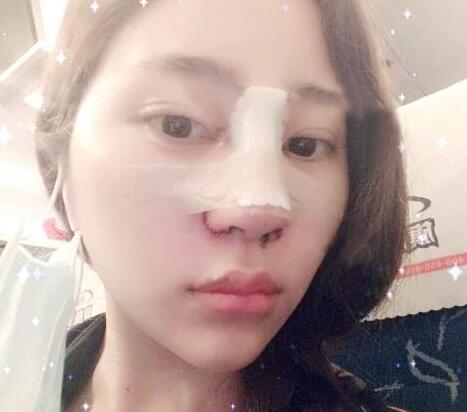 蘇州明基醫(yī)院醫(yī)療美容科做鼻綜合整形怎么樣？蘇州明基鼻綜合整形案例