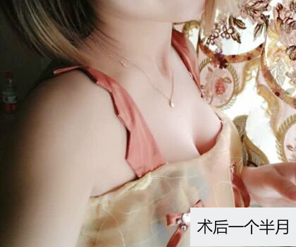 深圳博美整形醫(yī)生劉超做自體脂肪隆胸怎么樣？自體脂肪隆胸案例