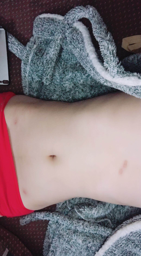 深圳晨曦整形醫(yī)院吉米斯做腰腹吸脂怎么樣？附吉米斯醫(yī)生腰腹吸脂案例