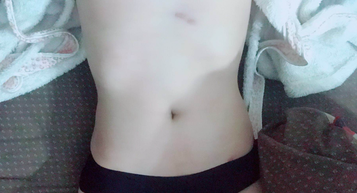 深圳晨曦整形醫(yī)院吉米斯做腰腹吸脂怎么樣？附吉米斯醫(yī)生腰腹吸脂案例