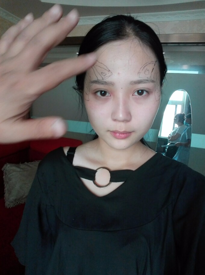 西安華仁醫(yī)院整形美容中心做自體脂肪填充效果怎么樣？附耿延鵬整形案例