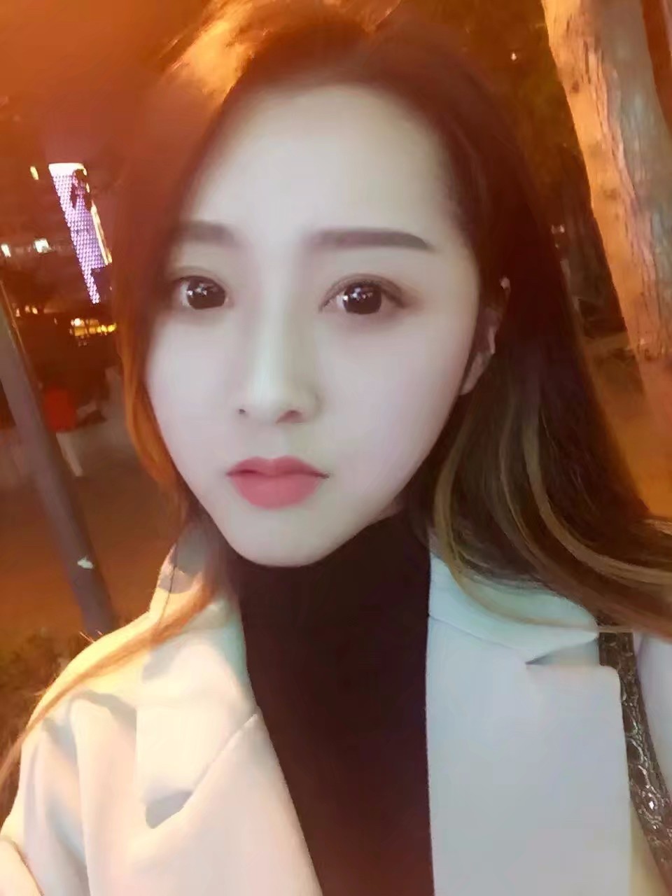 西安米蘭柏羽整形醫(yī)院李旭平做切開雙眼皮效果怎么樣？附案例