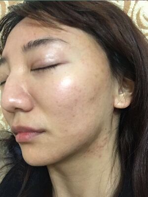 重慶柏漫醫(yī)療美容診所做激光祛痘效果怎么樣？白亞亞激光祛痘案例