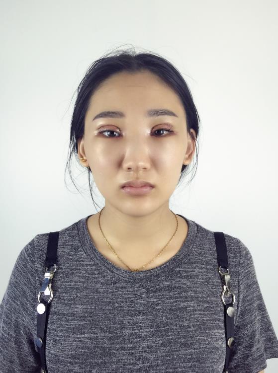 武漢中翰整形外科醫(yī)院沈磊醫(yī)生做切開(kāi)雙眼皮怎么樣？附沈磊切開(kāi)雙眼皮案例