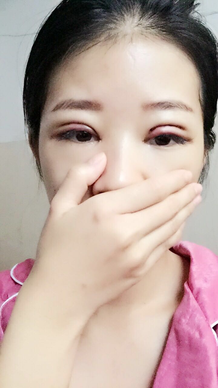 深圳晨曦醫(yī)療整形醫(yī)生吉米斯做切開雙眼皮怎么樣？吉米斯切開雙眼皮案例效果