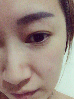 重慶五洲女子醫(yī)院整形美容中心做光子嫩膚怎么樣？淡明斌醫(yī)生光子嫩膚案例