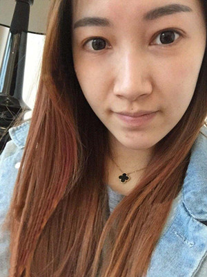重慶五洲女子醫(yī)院整形美容中心做光子嫩膚怎么樣？淡明斌醫(yī)生光子嫩膚案例