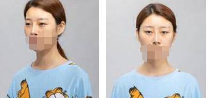 太原歐美蓮整形醫(yī)院丁曉峰醫(yī)生做雙眼皮怎么樣？丁曉峰雙眼皮手術(shù)案例分享