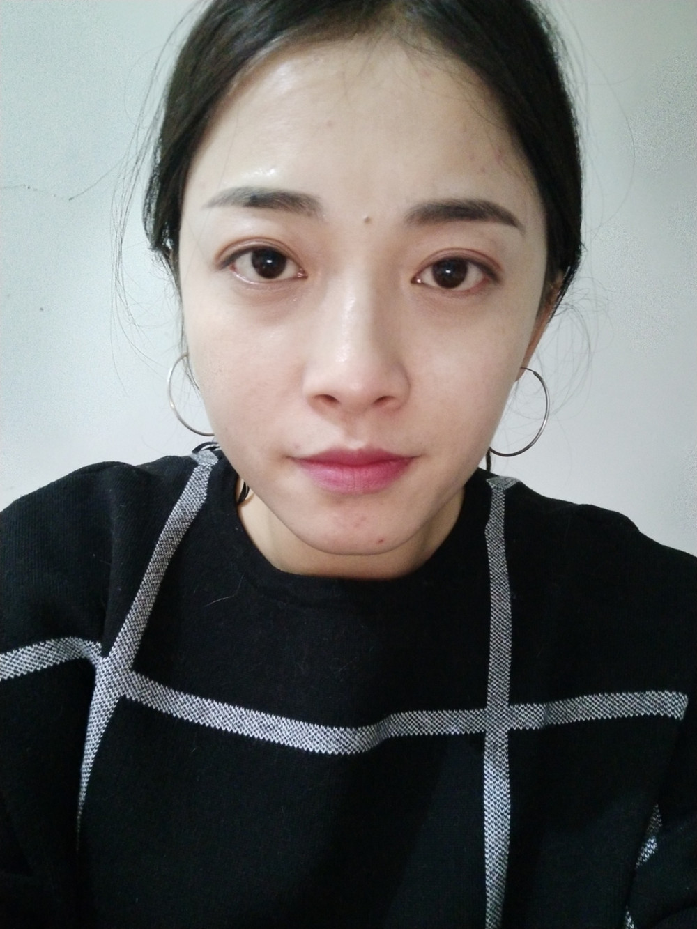 重慶當(dāng)代整形李敏旭醫(yī)生做皮秒激光祛斑效果怎么樣？附皮秒激光祛斑案例