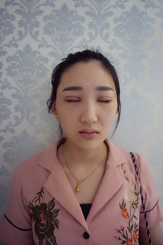 武漢中翰整形外科醫(yī)院沈磊醫(yī)生做切開(kāi)雙眼皮怎么樣？附沈磊切開(kāi)雙眼皮案例