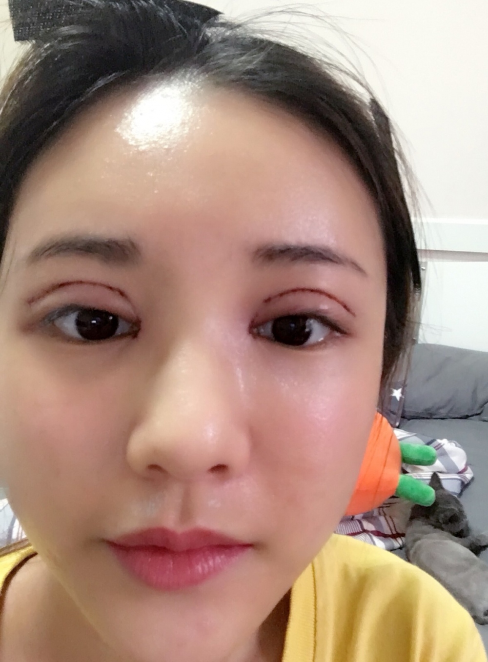鄭州銘藝整形醫(yī)生陳濤做切開雙眼皮怎么樣？鄭州銘藝切開雙眼皮案例
