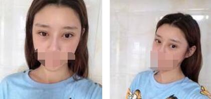 太原歐美蓮整形醫(yī)院丁曉峰醫(yī)生做雙眼皮怎么樣？丁曉峰雙眼皮手術(shù)案例分享