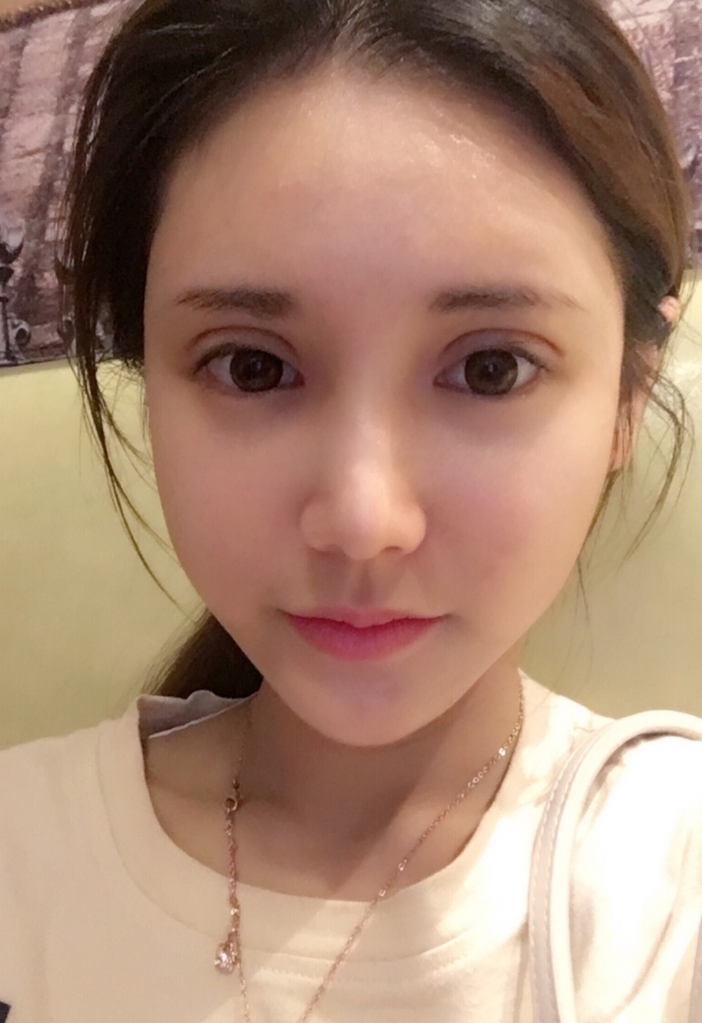 鄭州銘藝整形醫(yī)生陳濤做切開雙眼皮怎么樣？鄭州銘藝切開雙眼皮案例