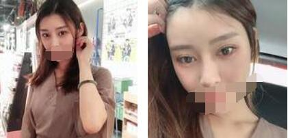 太原歐美蓮整形醫(yī)院丁曉峰醫(yī)生做雙眼皮怎么樣？丁曉峰雙眼皮手術案例分享