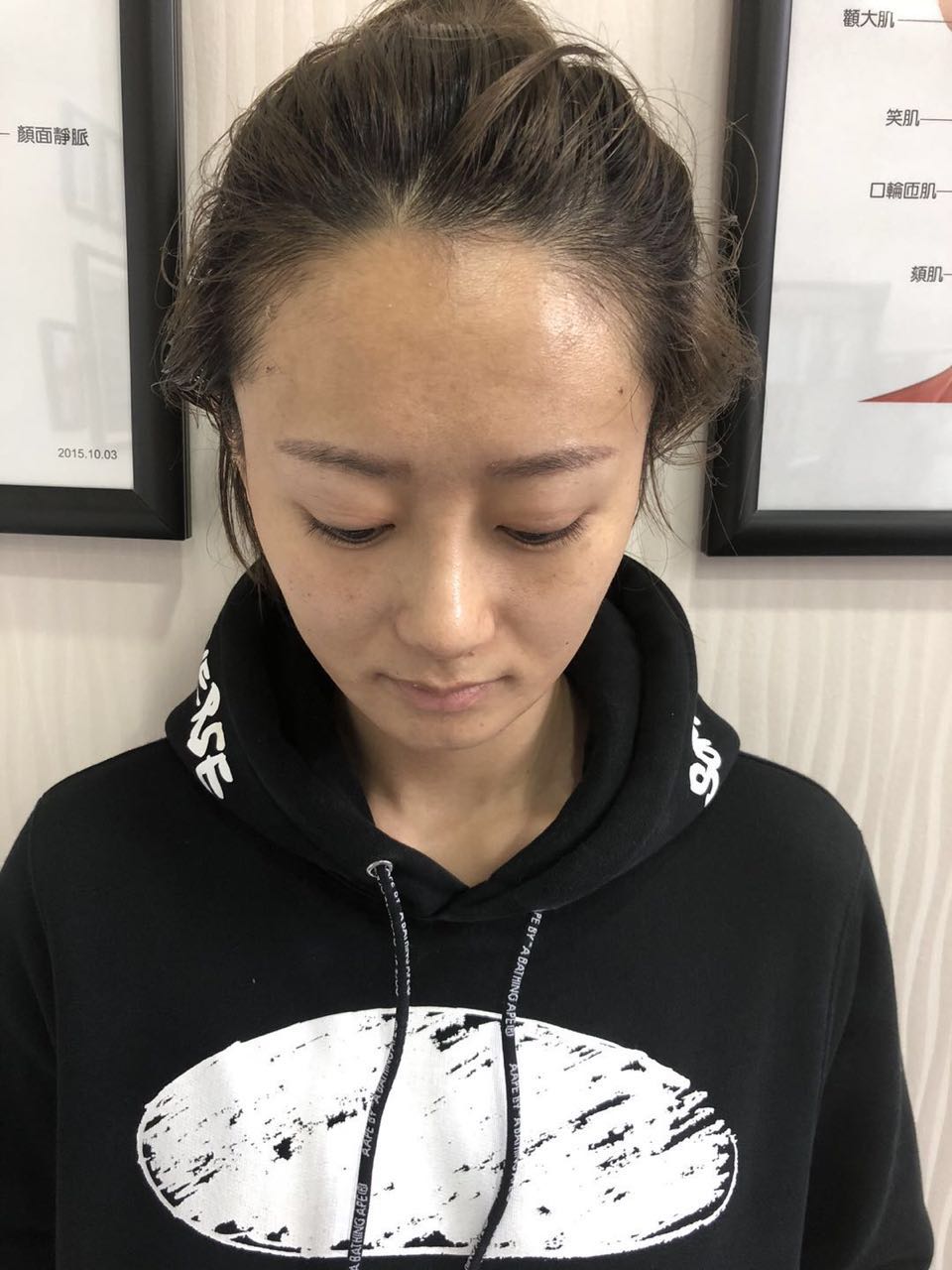 杭州迪美整形常德成醫(yī)生做鼻綜合整形技術(shù)怎么樣？附鼻綜合整形案例