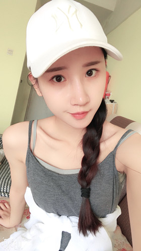 湛江澳泰整形醫(yī)院彭鑫醫(yī)生做自體脂肪豐蘋(píng)果肌+太陽(yáng)穴案例效果對(duì)比圖