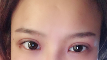 長(zhǎng)春麥西美嘉整形醫(yī)生王圣博做雙眼皮手術(shù)效果怎么樣？附雙眼皮案例