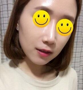 信陽東方藝美容醫(yī)院劉力萌做玻尿酸去法令紋效果怎么樣？附案例效果對比圖