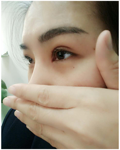營口臻美醫(yī)療整形醫(yī)生閆迎軍做雙眼皮效果怎么樣？附雙眼皮案例對(duì)比圖