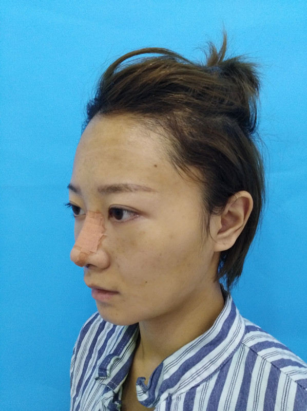 杭州迪美整形常德成醫(yī)生做鼻綜合整形技術(shù)怎么樣？附鼻綜合整形案例