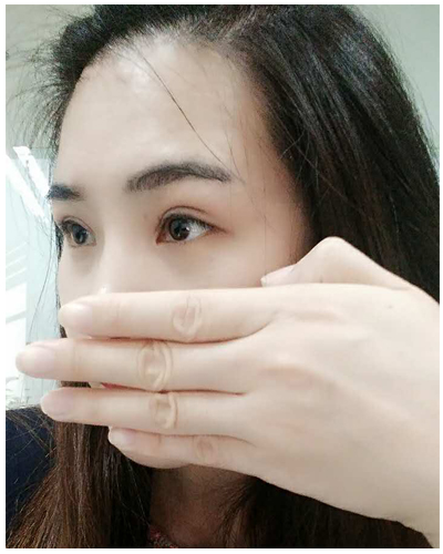 營口臻美醫(yī)療整形醫(yī)生閆迎軍做雙眼皮效果怎么樣？附雙眼皮案例對(duì)比圖