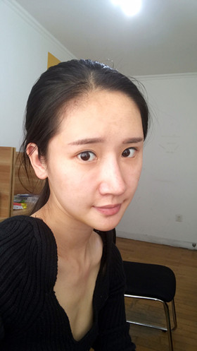 湛江澳泰整形醫(yī)院彭鑫醫(yī)生做自體脂肪豐蘋(píng)果肌+太陽(yáng)穴案例效果對(duì)比圖