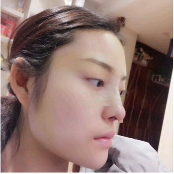 武漢維納斯整形醫(yī)院韓國濤醫(yī)生做鼻綜合整形怎么樣？附鼻綜合整形案例