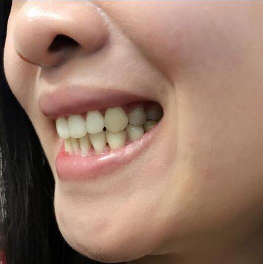 重慶嘉悅口腔醫(yī)院周繼祥醫(yī)生做金屬托槽矯正效果怎么樣？附案例效果對(duì)比圖