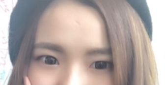 長(zhǎng)春麥西美嘉整形醫(yī)生王圣博做雙眼皮手術(shù)效果怎么樣？附雙眼皮案例