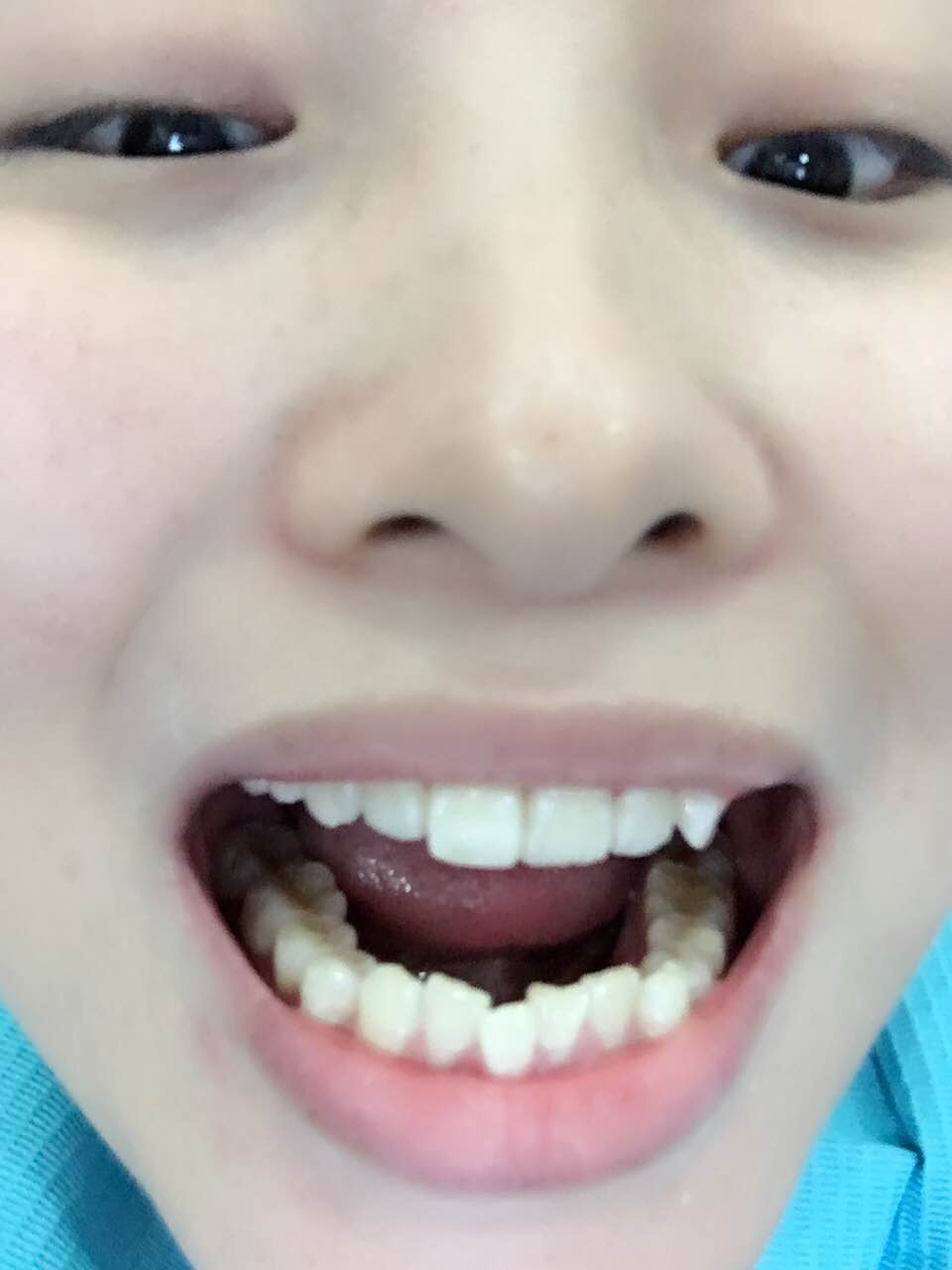 鄭州壹加壹整形醫(yī)院楊永利醫(yī)生做牙齒隱形矯正怎么樣？附牙齒隱形矯正案例