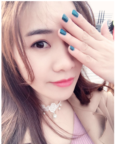 營口臻美醫(yī)療整形醫(yī)生閆迎軍做雙眼皮效果怎么樣？附雙眼皮案例對(duì)比圖