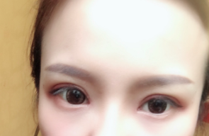 長(zhǎng)春麥西美嘉整形醫(yī)生王圣博做雙眼皮手術(shù)效果怎么樣？附雙眼皮案例